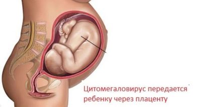 цитомегаловирусная инфекция при беременности