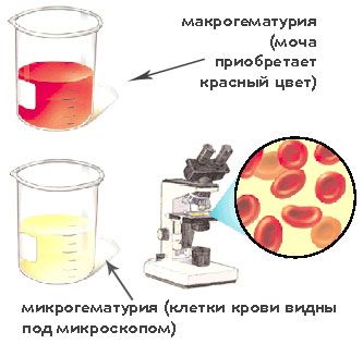 Определение гематурии