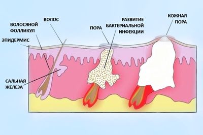 Что делать, если образовался фурункул на руке у ребенка