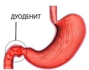 дуоденит,_