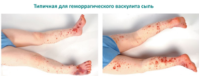 Геморрагический васкулит у детей