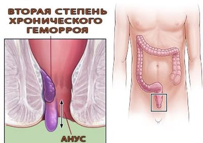 Геморрой 2 степени