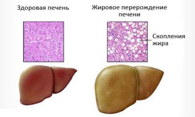 Особенности развития и лечения вирусного гепатита С 3 генотипа