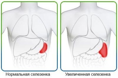 Увеличение селезенки