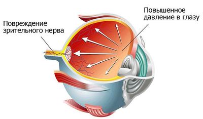 Повышенное глазное давление