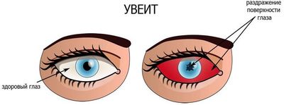 Симптомы увеита