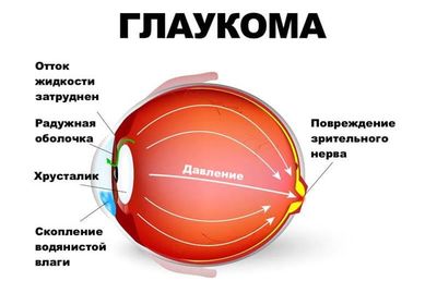 симптомы глаукомы