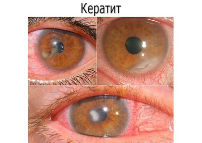 Симптомы кератита