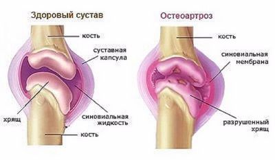 больные суставы
