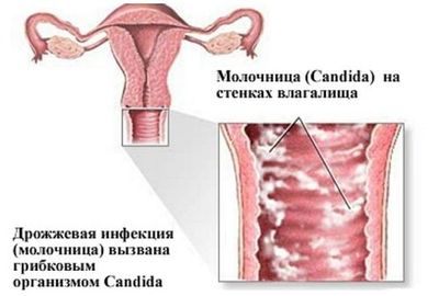 Причины проявления и лечение хронической молочницы