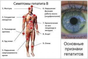 Симптомы гепатиты В