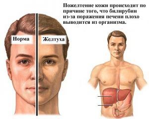 Хроническая форма гепатита