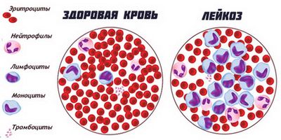 Хронический лимфолейкоз в подробностях