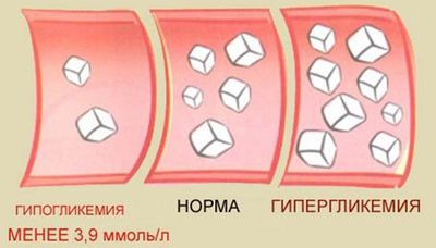 Гипогликемия