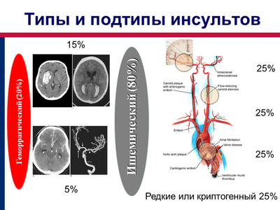 Типы и подтипы инсультов