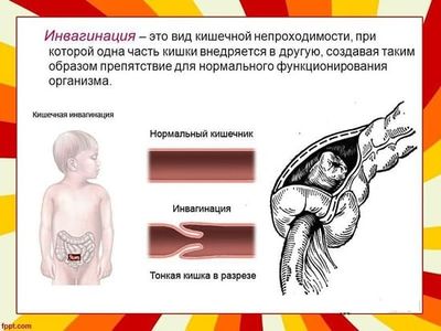 Инвагинация кишечника