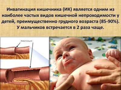 Инвагинация кишечника
