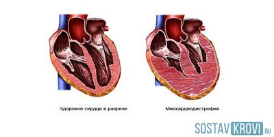 Дистрофические изменения миокарда