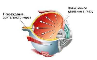 Методики измерения внутриглазного давления при подозрении на глаукому