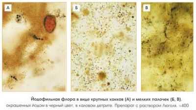 О чем говорит йодофильная флора в кале