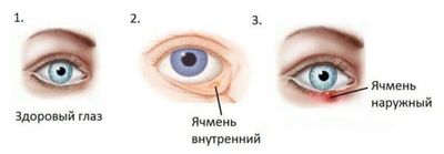 лечение конъюнктивита соком алоэ