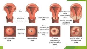 Как лечить вирус папилломы человека? Самые эффективные методы