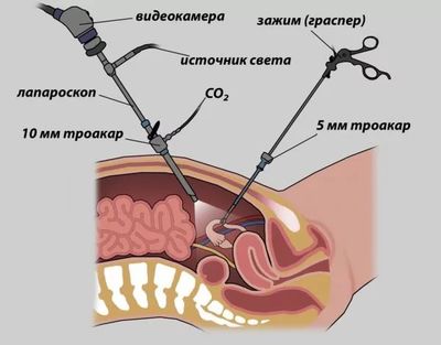 Лапароскопия