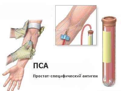 проверка простаты
