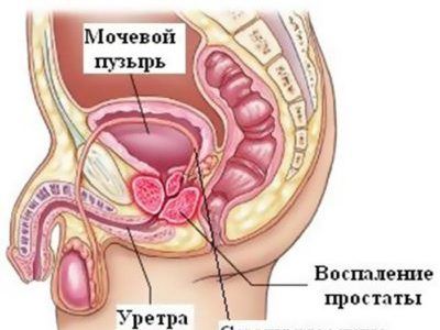 Как проводится диагностика простатита у мужчин