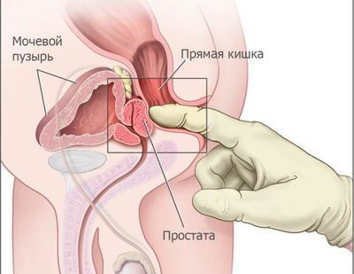 Прощупывание предстательной железы