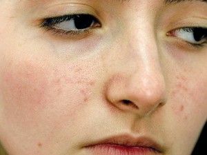 Как избавиться от пятен от прыщей на лице