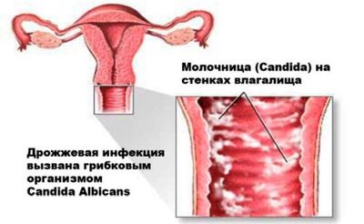 Как выглядят симптомы молочницы у женщины?