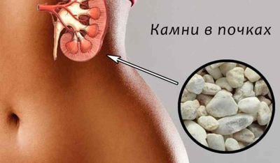 конкременты