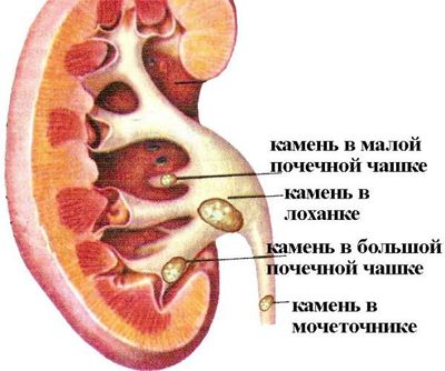 Симптомы и лечение при камне в мочеточнике