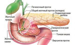 камни в поджелудочной железе