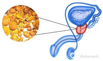 Избавляемся от камней в простате