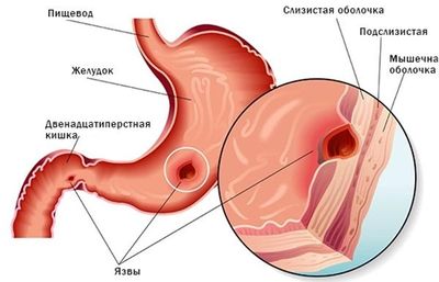 Заболевания желудка, пищевода или 12-перстой кишки