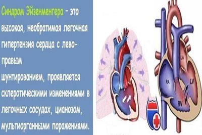 Синдром Эйзенменгера