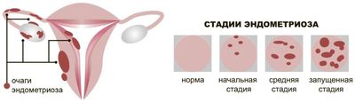 Когда делать УЗИ при эндометриозе