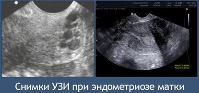 Когда делать УЗИ при эндометриозе
