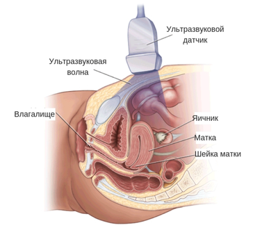 Когда делать УЗИ при эндометриозе