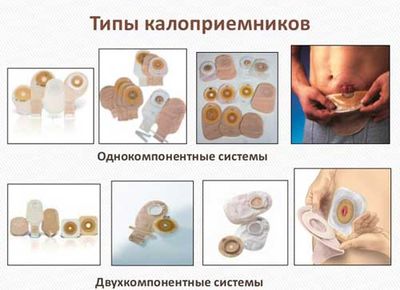 виды калоприемников
