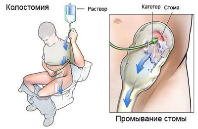 промывание стомы
