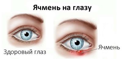 Особенности лечения конъюнктивита у детей 3 лет