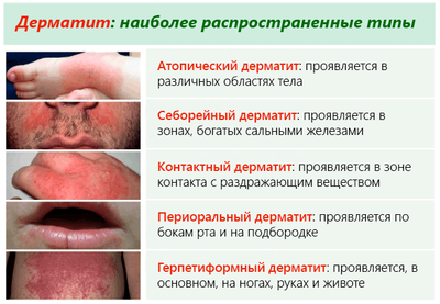 Виды кожных дерматитов: симптомы и лечение