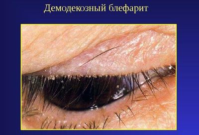 Симптомы демодекозного блефарита