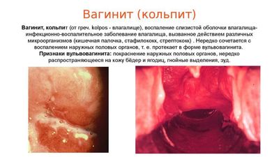 Кровянистые выделения при молочнице