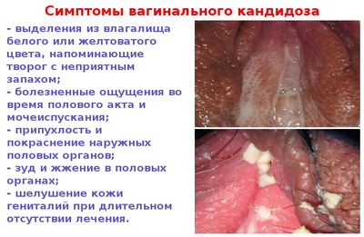Кровянистые выделения при молочнице