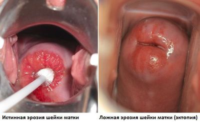 Кровянистые выделения при молочнице