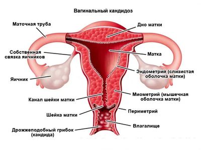 Кровянистые выделения при молочнице